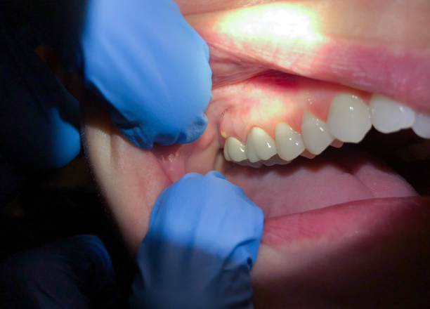 Best Emergency Denture Repair in Roxboro, NC
